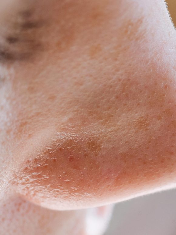 poros Milium, puntos negros y filamentos sebáceos