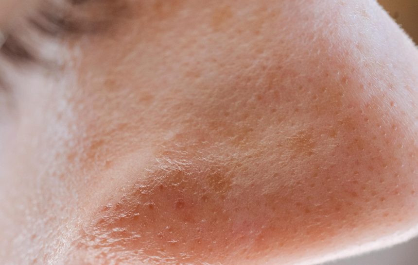 poros Milium, puntos negros y filamentos sebáceos