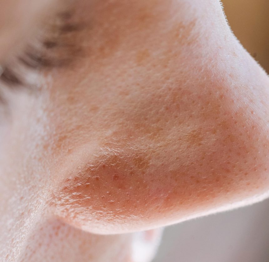 Milium, puntos negros y filamentos sebáceos